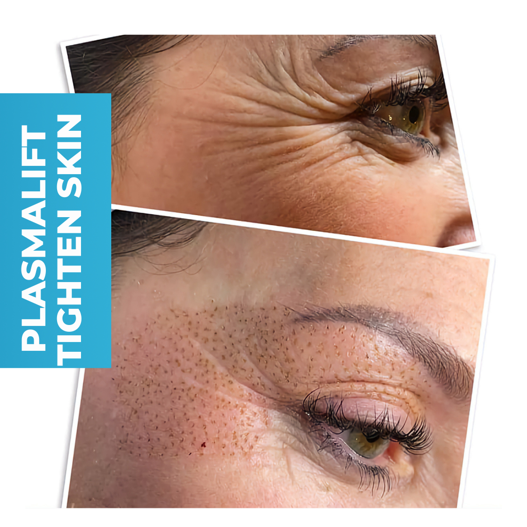 BeyondBBVIP's tweet image. 😲 WOW, 6 WEEKS in and she is already SNATCHED! 👍

Plasma Skin Tightening is a revolutionary, non-invasive alternative treatment to traditional surgery. The treatment helps eliminate excessive tissue that causes sagging skin, unwanted wrinkles, stretch marks, and even dimini