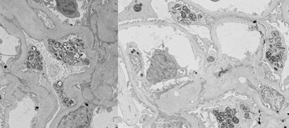 JeanHouMD's tweet photo. Podocyte gluttony: Incidental finding in 64 yo F with AKI. Super-constipated podocytes (Mega-Chang Bodies 😂) after Thanksgiving dinner, STUFFED with lipid inclusions. Puzzling, until patient said "Oh, I forgot to tell you I have lupus!".  Plaquenil-associated phospholipidosis 🤦‍♀️ https://t.co/E00hfBVV0k