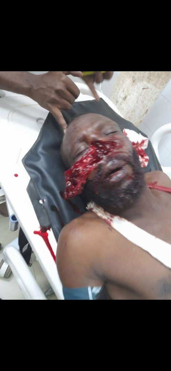 MHussien7511's tweet photo. GRAPHIC: 
A protester shot in head by the terrorist @aftaburhan's forces during #مليونية30نوفمبر

While the f*** @volkerperthes @SecBlinken @USCDASudan @UKinSudan &amp; @NorwayAmbSudan still back partnering #Sudan army!

Either 100% CIVIL RULE or #SudanUprising will ignite more!✌🏾🔥 https://t.co/EigeTTiGnA