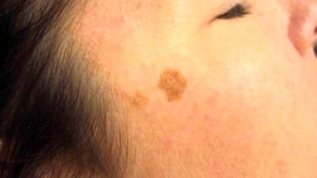 zazoomblog's tweet image. Macchie della pelle: i 5 rimedi veloci e naturali dall’effetto assicurato - #Macchie #della #pelle: #rimedi zazoom.it/2021-12-02/mac…