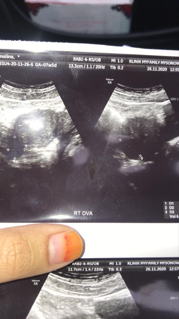 Arlyine's tweet photo. Semalam genap setahun mummy &amp; daddy kehilangan awak berdua  . Semoga awak tenang dekat sana . Cukup setahun juga mummy try untuk move on &amp; kuat kan diri untuk terima semua ni . Hampir setiap hari i cry untuk belajar terima semua ni . https://t.co/W82y8ojk24