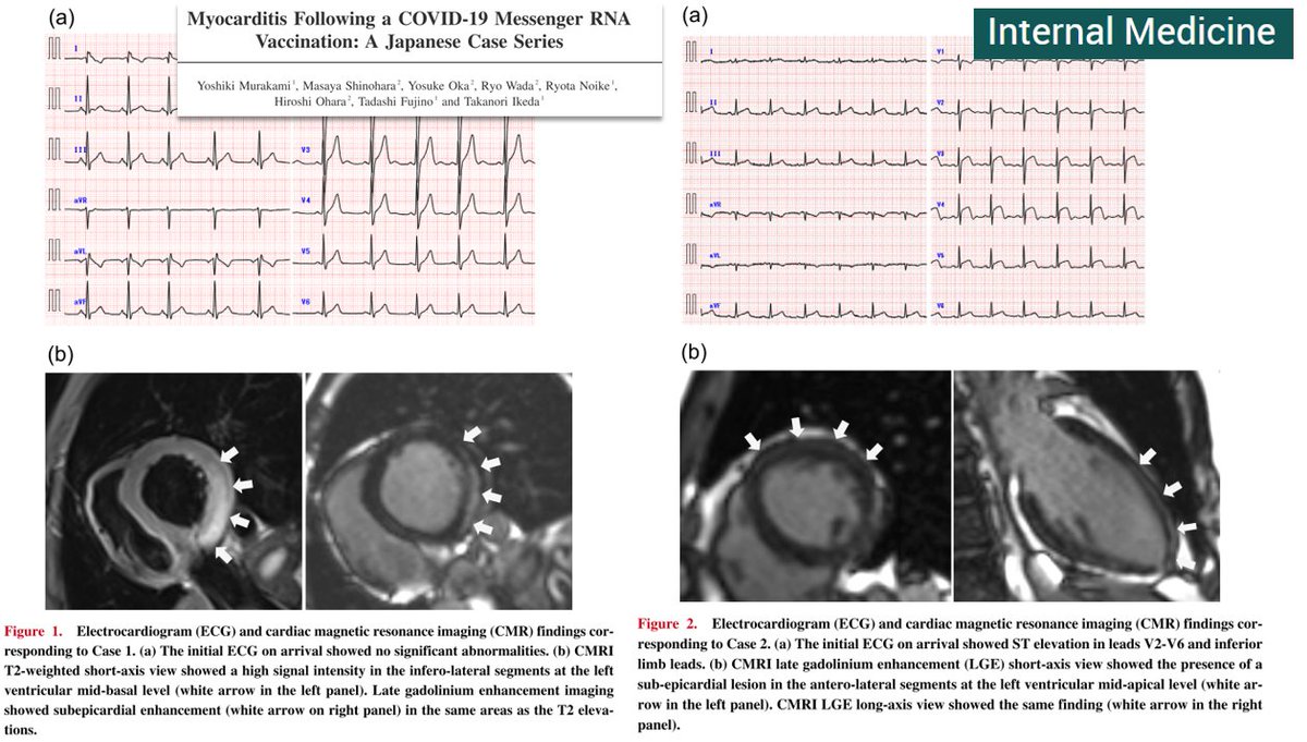 DrJohnB2's tweet photo. 2 cases from Japan of myocarditis following #COVIDVaccination (Pfizer-BioNTech): 
https://t.co/ejoUPXHZsv
A 27 and 38-year-old man.
"The long-term outcomes of COVID-19 vaccine-related myocarditis remain unclear." https://t.co/nbocmz2n6G