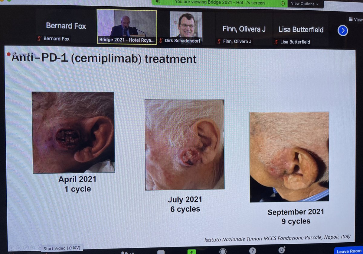 BernardAFox's tweet photo. 2) Prof @PAscierto #immunotherapy Guru @istitutotumori @FondMelanoma talks real world data anti-PD1 4 cutaneous squamous cell CA (#CSCC) / more data immunotherapy works in older population 80-93 y/o /lots of examples #cemiplimab /before PD1 these pts had no chance/#IOBridge2021 https://t.co/1yn6oH8cCf