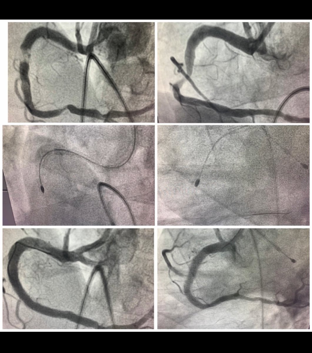 BoopathyCardio's tweet image. In the era of Coronary Lithotripsy, Rotablation still works for Calcified lesions. #Rotablation #CalcifedCoronaries #atherectomy @BSCCardiology @BSCCardioAPAC @mirvatalasnag @ccclivecases @Dr_AshokSeth @_PraveenChandra @ShockwaveIVL @njohncamm @ajaykirtane