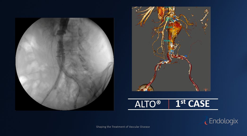 endologix's tweet photo. Another successful #ALTO case in the EU!
This is the first #ALTO case in Ospedale Civile di Vigevano, thank you to Dr. Giovanni Ambrosino and his team for the great job! 
Great final result for a challenging anatomy! #EVARevolved #AAA https://t.co/b1BVCrO3Bm