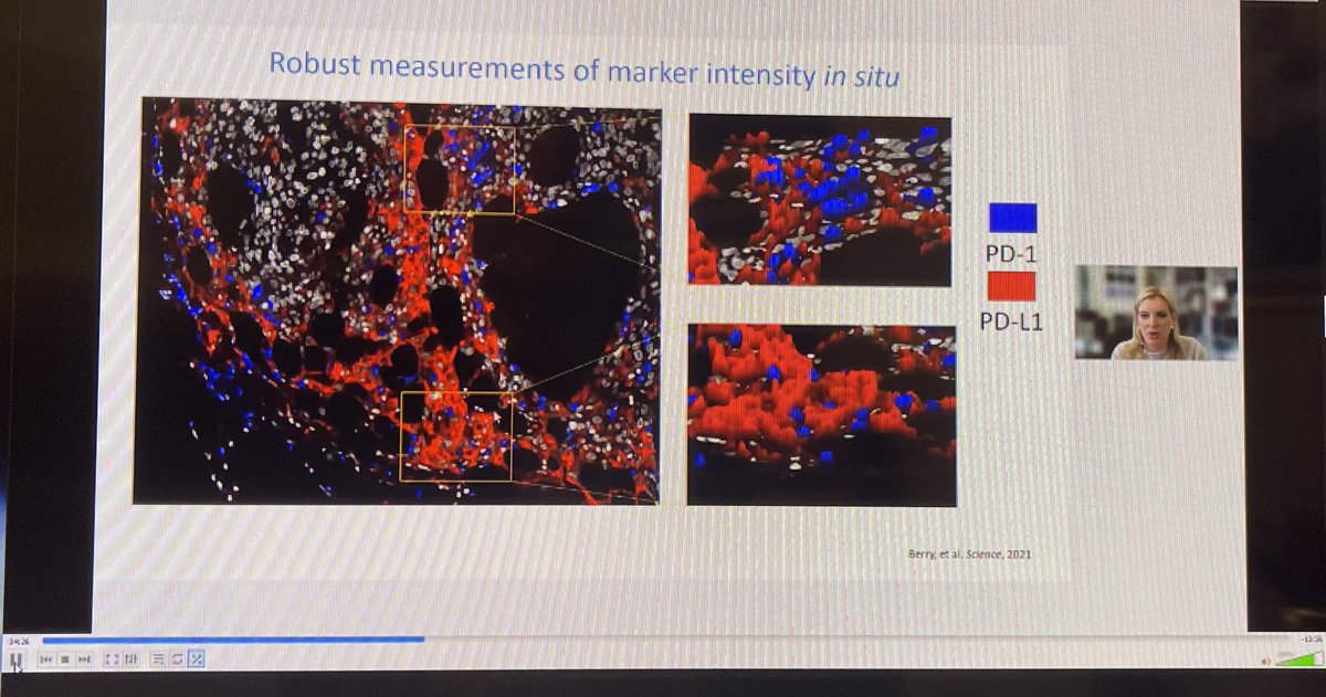 BernardAFox's tweet photo. Prof Janis Taube #multiplex IF & pathology Guru @HopkinsMedicine provides unpublished data & novel insights into #cancer patients most likely to respond to #immunotherapy/will be future to determine pt tx @AkoyaBio @Ultivue @NeoGenomics @FondMelanoma #IOBridge2021 @PAscierto https://t.co/xOFbWct4te