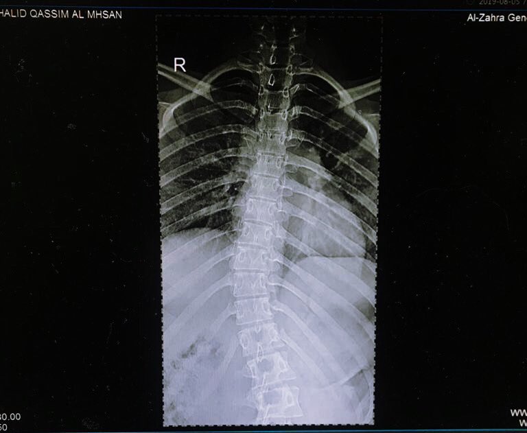 Rkm173's tweet photo. - Perfect imperfection - 
the strength is there in every curve of my spine, i’m capable of anything! .. 
my diagnosis does not define me
“ SPEAK up for scoliosis “ 💓
#scoliosiswarrior | double S curve | https://t.co/8B3HtOKbry