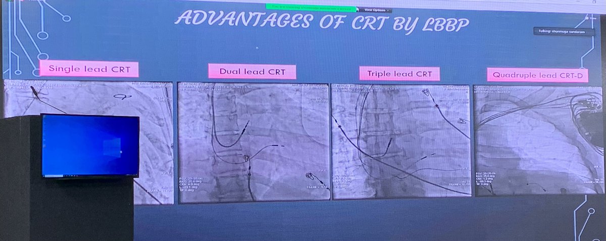 drmdsadiqcardio's tweet photo. Breath-taking talk by @shunmug_his_mdu at #CSI2021 on #LBBP #leftbundlepacing #EPeeps #CardioTwitter https://t.co/g4EMj8Q5Sy