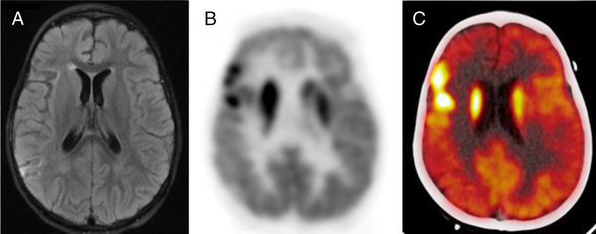 Current Issue: A 3-Year-Old Girl With Recent Onset of Seizures and Asymmetric Hypermetabolic Activity on 18F-FDG PET/CT dlvr.it/SDcDrX