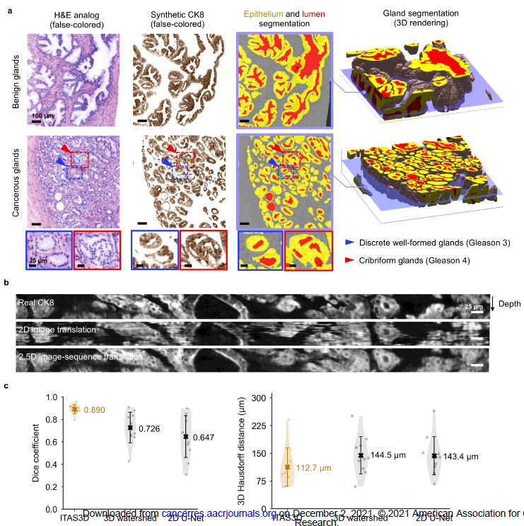 Anant Madabhushi (@anantm) on Twitter photo 2nd @CCIPD_Case #computationalpathology paper for the week. "Prostate cancer risk stratification via non-destructive 3D pathology with deep learning-assisted gland analysis" in <a href="/CR_AACR/">Cancer Research</a> led by <a href="/jonliu123/">Jonathan Liu</a>. #3Dpathomics & #AI for #3Dpathology.
tinyurl.com/4jd9ay7b 2nd @CCIPD_Case #computationalpathology paper for the week. "Prostate cancer risk stratification via non-destructive 3D pathology with deep learning-assisted gland analysis" in <a href="/CR_AACR/">Cancer Research</a> led by <a href="/jonliu123/">Jonathan Liu</a>. #3Dpathomics & #AI for #3Dpathology.
tinyurl.com/4jd9ay7b