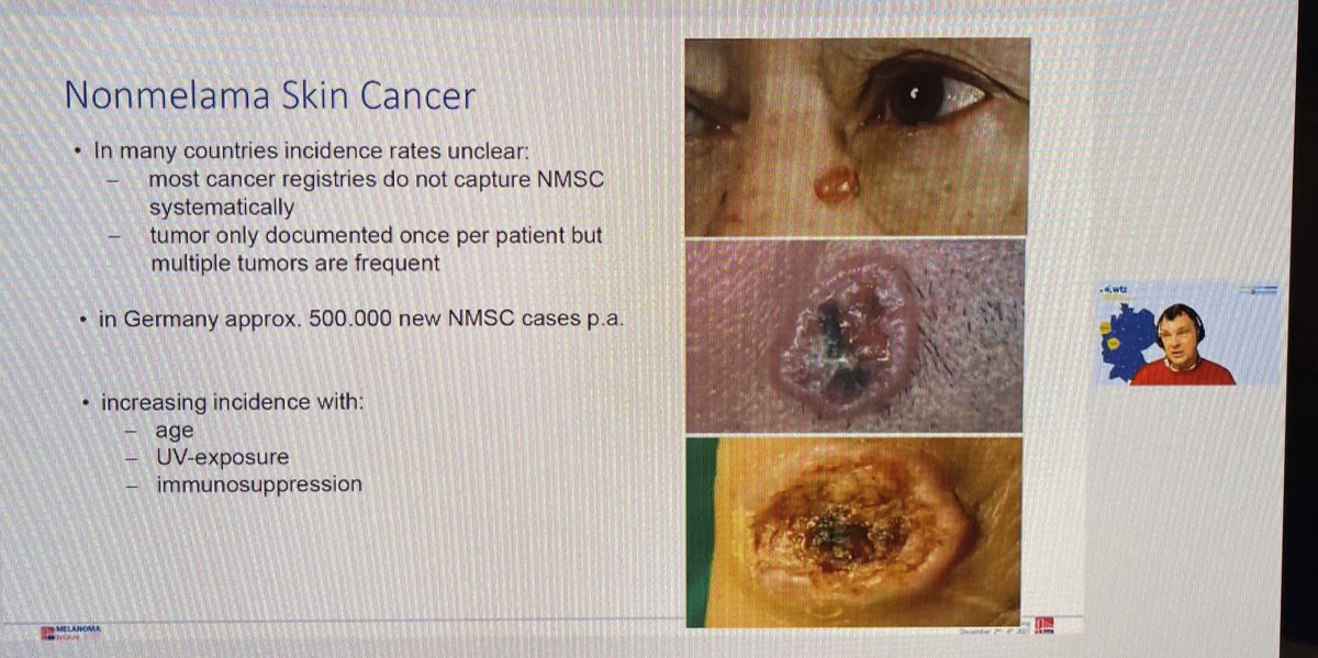 BernardAFox's tweet photo. Prof Dirk Schadendorf #skin #cancer expert @UniklinikEssen provides perspective on aging European population/it will have increased incidence of non-#melanoma skin cancers/discusses targeted #HHI & #immunotherapy/responses in >70 y/o @FondMelanoma #IOBridge2021 @PAscierto https://t.co/PvWGlkRKDj