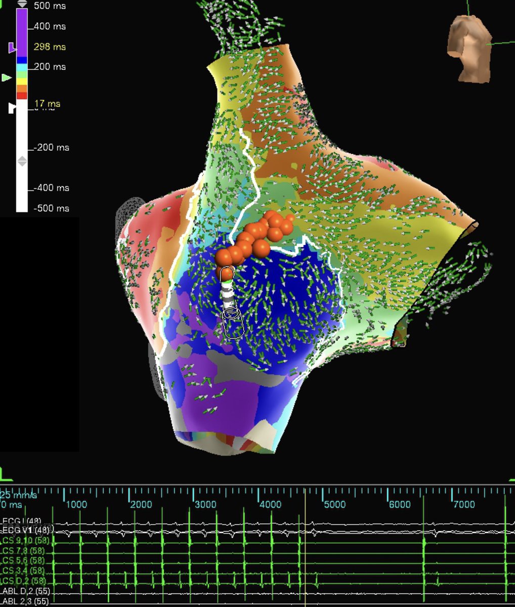 Great use of #OT on #EnSiteX for this patient with an RA cannulation scar. CS pace map vector arrows lead to the entrance into the area of late activation. Initiated flutter with RF then terminated during the same burn. 🔥

#EPeeps #HDGrid @AbbottCardio @EPDenault @XanderPaulEP