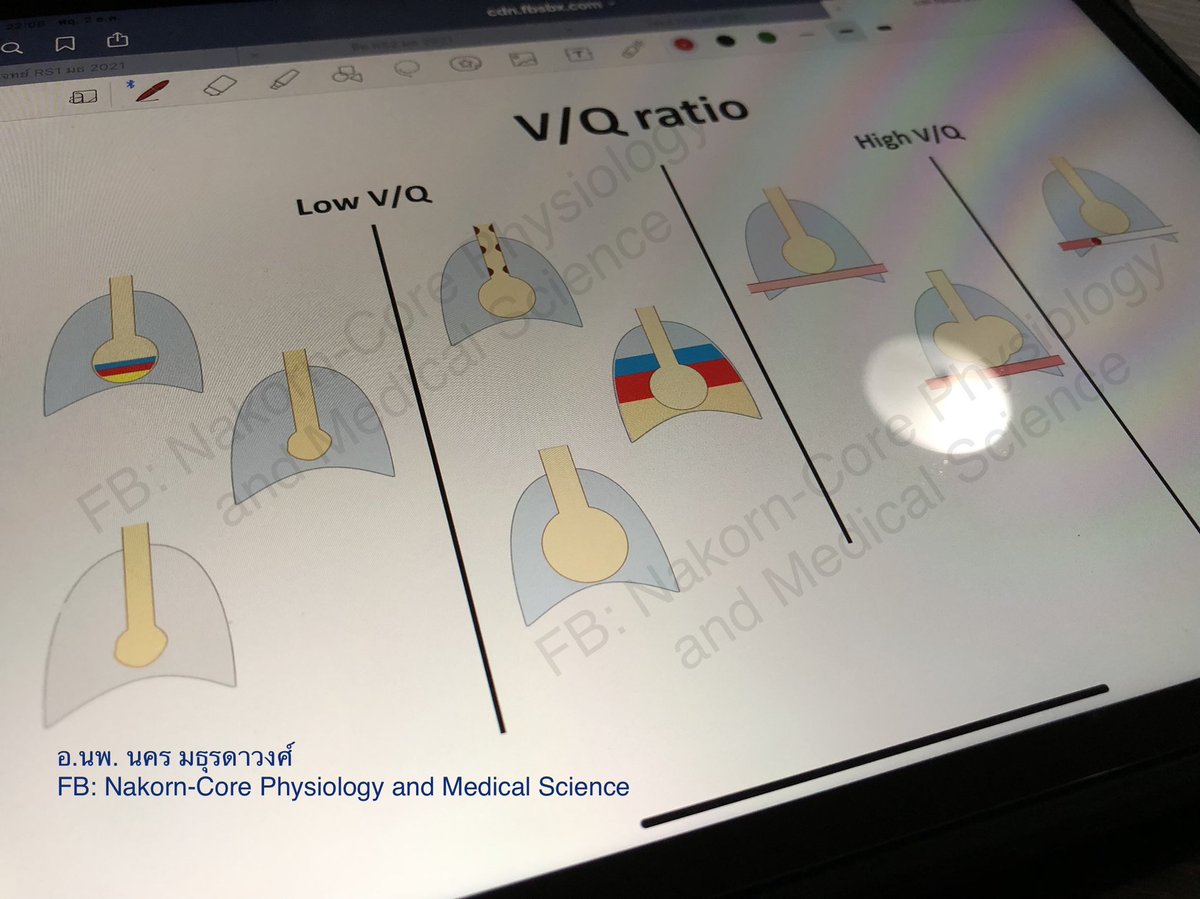 NNakorn5's tweet photo. วันนี้แอดมินมาติว
📚📚Physiology/Pathophysiology ของระบบหายใจครับ 😘
.
.
#นสพ #นศพ #แพทย์ #physio #ฟิสิโอ #ศรว #nl #NL1 #NLStep1 https://t.co/sSJ1zClYHv