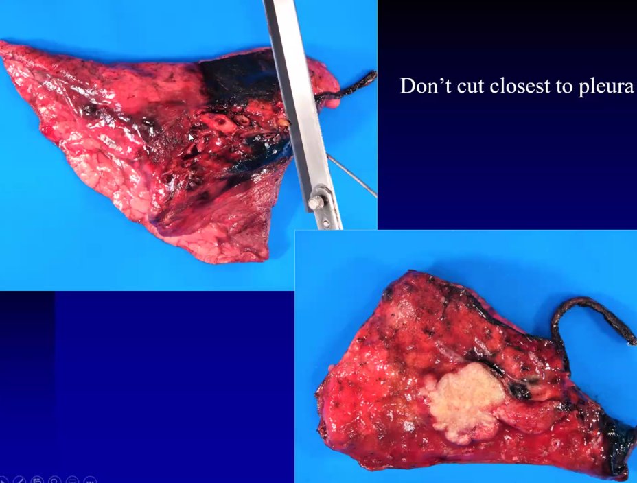 KMirza's tweet photo. Happening now! @AhusainPath sharing pearls of wisdom on #thoracicpath #frozensections in @VirtualPathGR - over 400 registrants! Join now, or watch recording later!

#VirtualPathGR cc: @SaraEWobker @RaulSGonzalezMD @ekhanafshar @Sara_Jiang @RodneyRohde @Blair_Holladay @damilnermd https://t.co/ULn3wyR8QQ