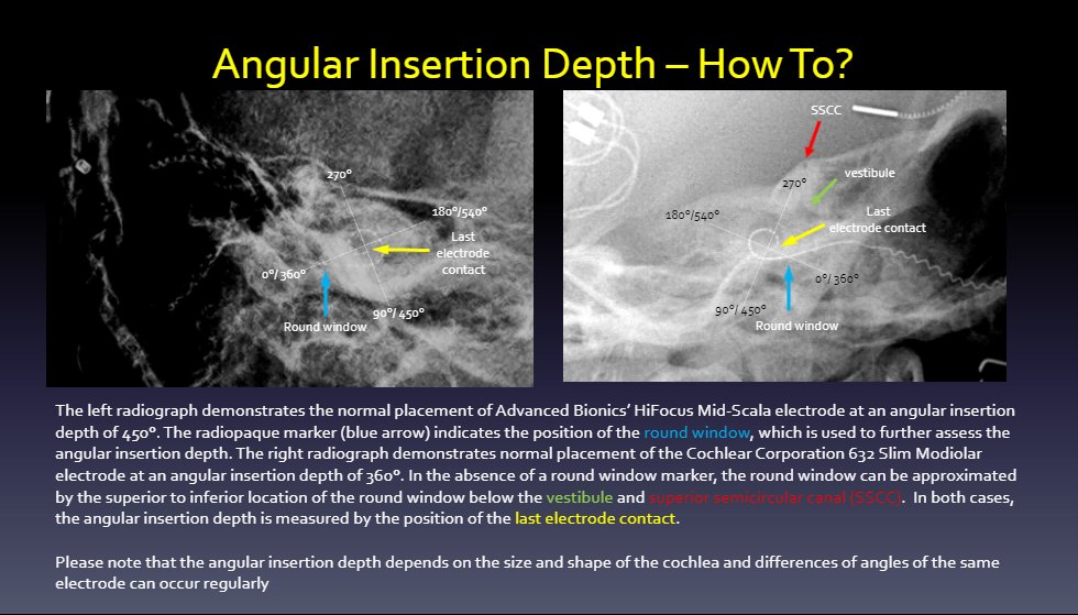francisdeng's tweet image. Our #RSNA21 exhibit on cochlear implants received a Certificate of Merit! 

Teaching point: Intracochlear electrode position is confirmed inferomedial to the vestibule using the landmark of the superior semicircular canal on modified Stenvers view radiograph.

HNEE-24