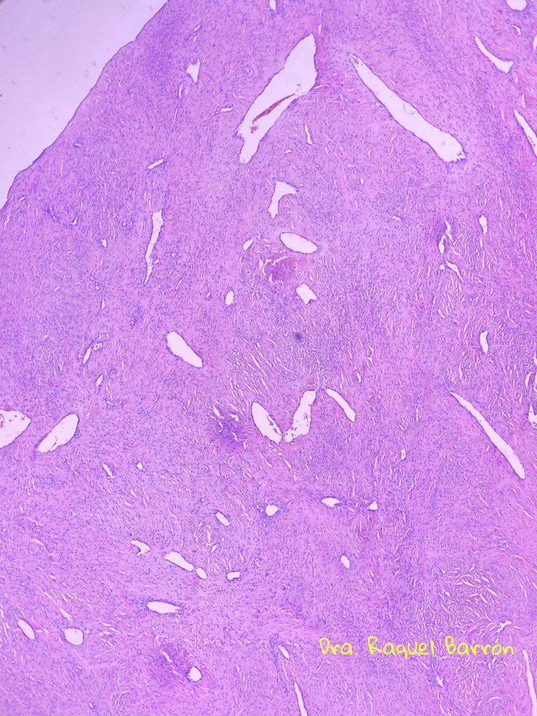 raquelbarron's tweet photo. A 12-year-old male, a tumor occupying the nostrils extends through the left sphenopalatine fossa to the ipsilateral infratemporal fossa and extends intracranially.  JUVENILE NASOPHARYNGEAL ANGIOFIBROMA #PathTwitter #PediPath #path https://t.co/PVkXUfXU9a