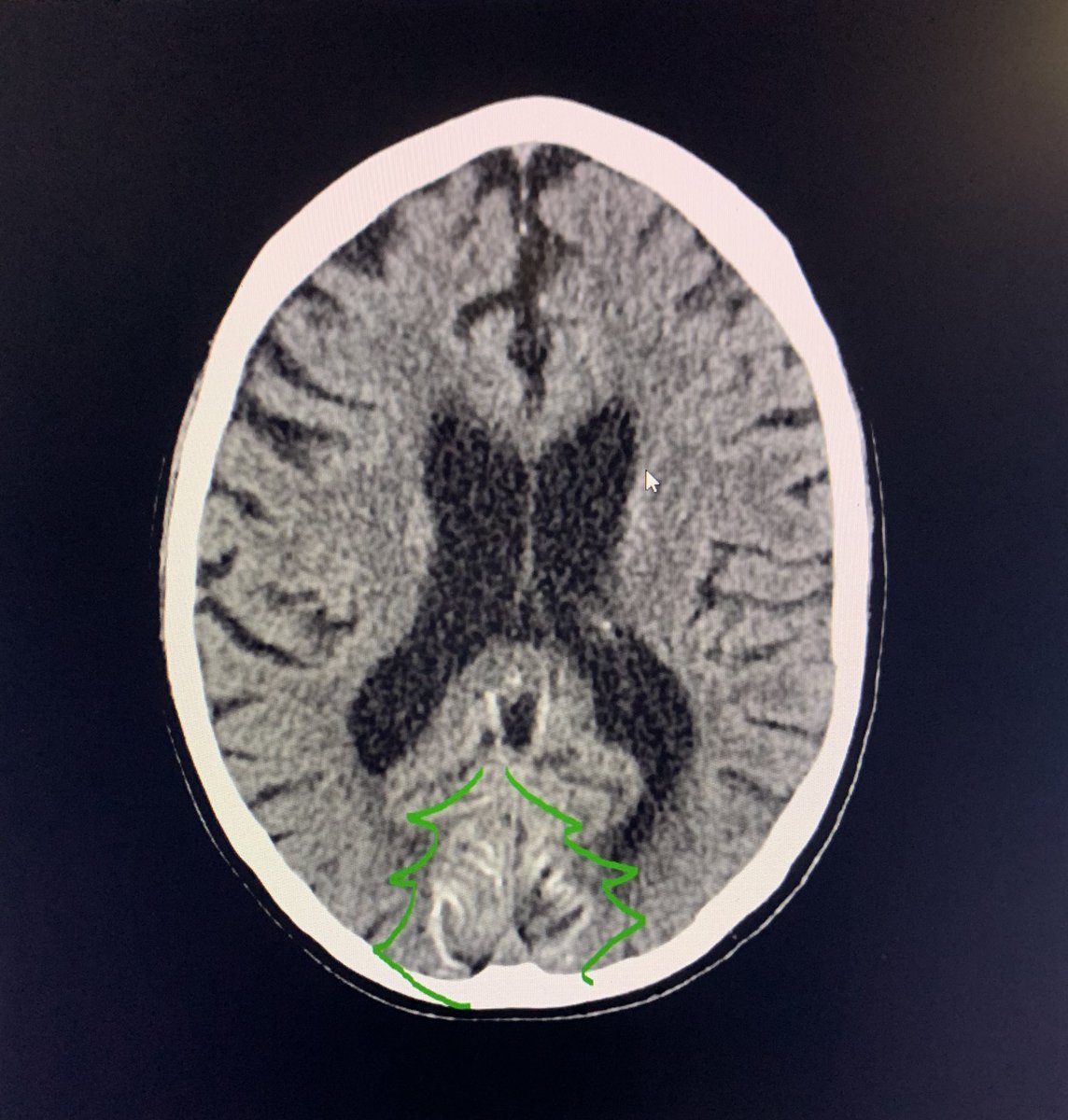 geraldinetranMD's tweet photo. Officially holiday season! Taking this as a “sign” I should stop by the Boston Commons Christmas tree lighting today. Occipital cortical laminar necrosis. #radiology #neuroradiology https://t.co/bxn4xM6X5Q