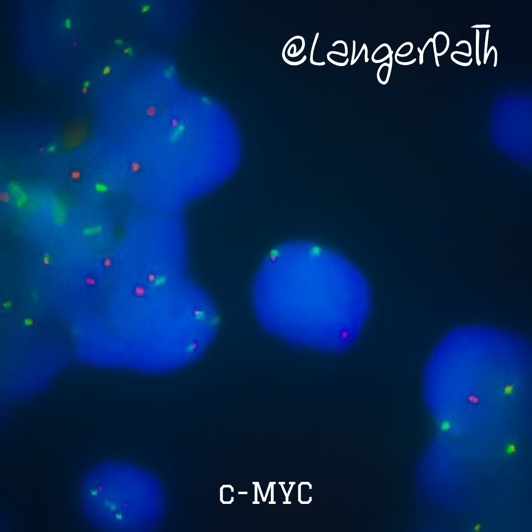 LangerPath's tweet photo. Cyto-Histo Correlation: Cervical lymph node of a child.
BURKITT LYMPHOMA
#cytohistocorrelation #cytopath #hemepath #pathology #cytology https://t.co/kN8Y2TmoMq