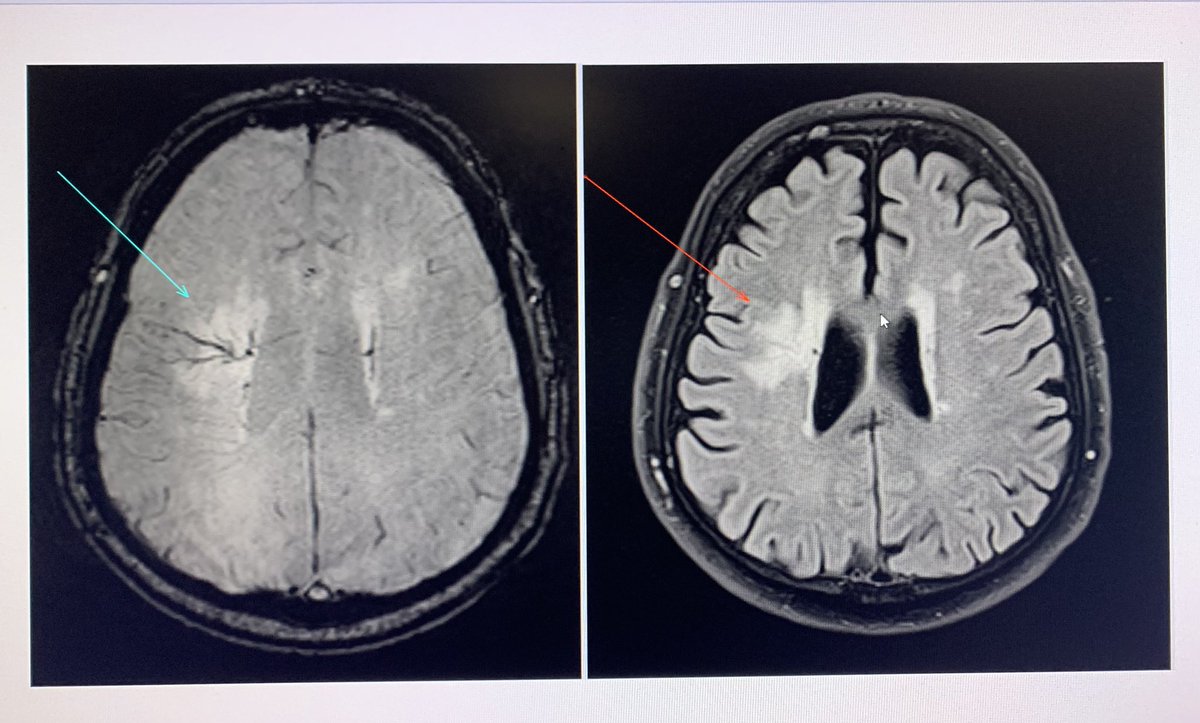 geraldinetranMD's tweet photo. Nice example of developmental venous anomaly today and review of the 5 vascular malformations: AVM, dAVF, cavernoma, capillary telangiectasia. #radiology #neuroradiology https://t.co/4SqISNtNqC