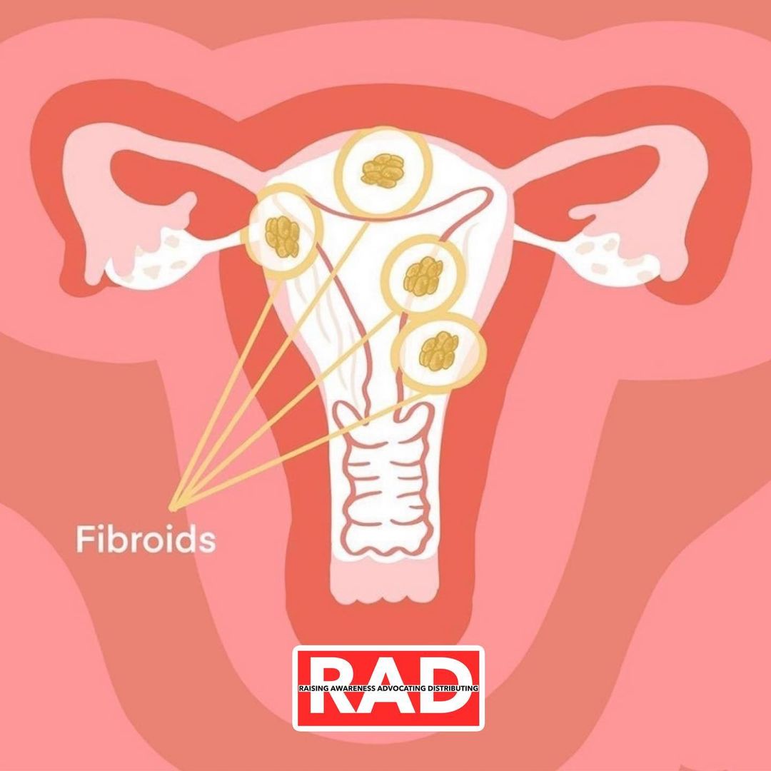 radinternatl's tweet photo. Are you one of the 70% of women who have experienced uterine fibroids? Or do you suffer some of the symptoms of fibroids? These include (but aren’t limited to) blood, clots, abdominal cramping, pelvic pain, and even heavy menstrual bleeding. https://t.co/LxOBRP8Ns3