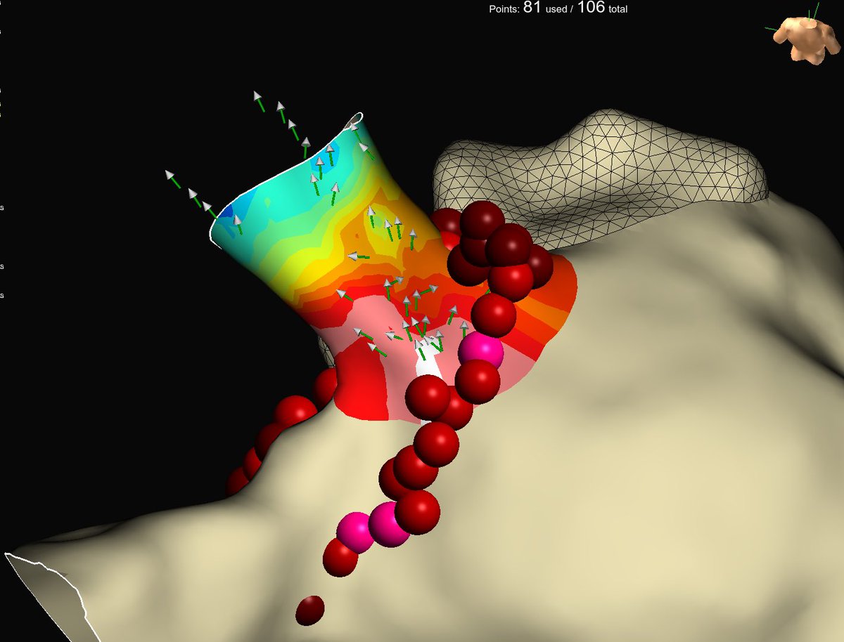 Simple yet eloquent demonstration of #OT to quickly identify PV gaps. <a href="/AbbottCardio/">Abbott Cardiovascular</a> #EnsiteX #HDGrid Map credit: <a href="/BrianOttoEP/">Brian Otto</a>