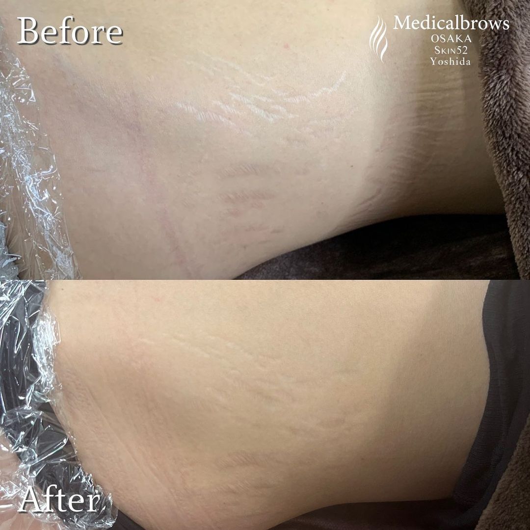 公式】メディカルブロー Medicalbrows【アートメイク】 on X