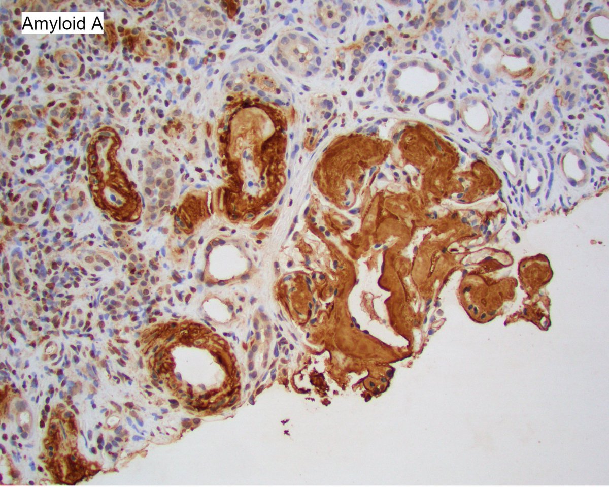 JZRenalPath's tweet photo. Striking biopsy in pt with nephrotic syndrome, hx of IVDU and HCV. Massive AA amyloidosis. Amyloid spicules by EM with amyloid uptake by podocytes and spillage into urinary space. #renalpath #nephropath https://t.co/bw4PC9K90e