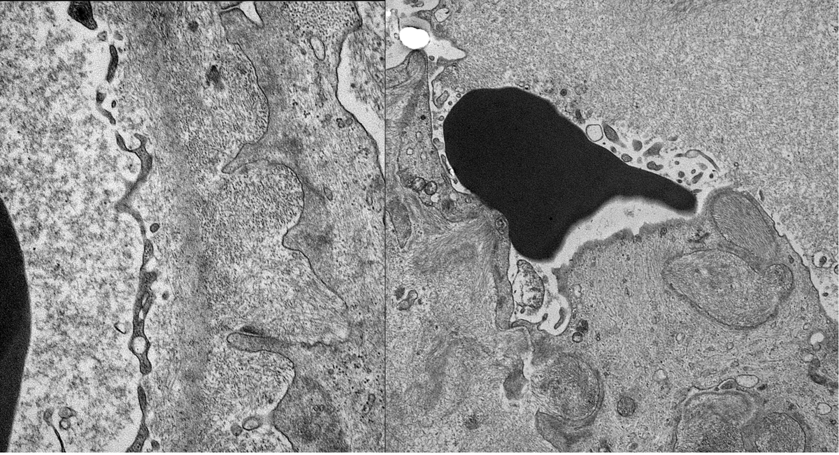 JZRenalPath's tweet photo. Striking biopsy in pt with nephrotic syndrome, hx of IVDU and HCV. Massive AA amyloidosis. Amyloid spicules by EM with amyloid uptake by podocytes and spillage into urinary space. #renalpath #nephropath https://t.co/bw4PC9K90e