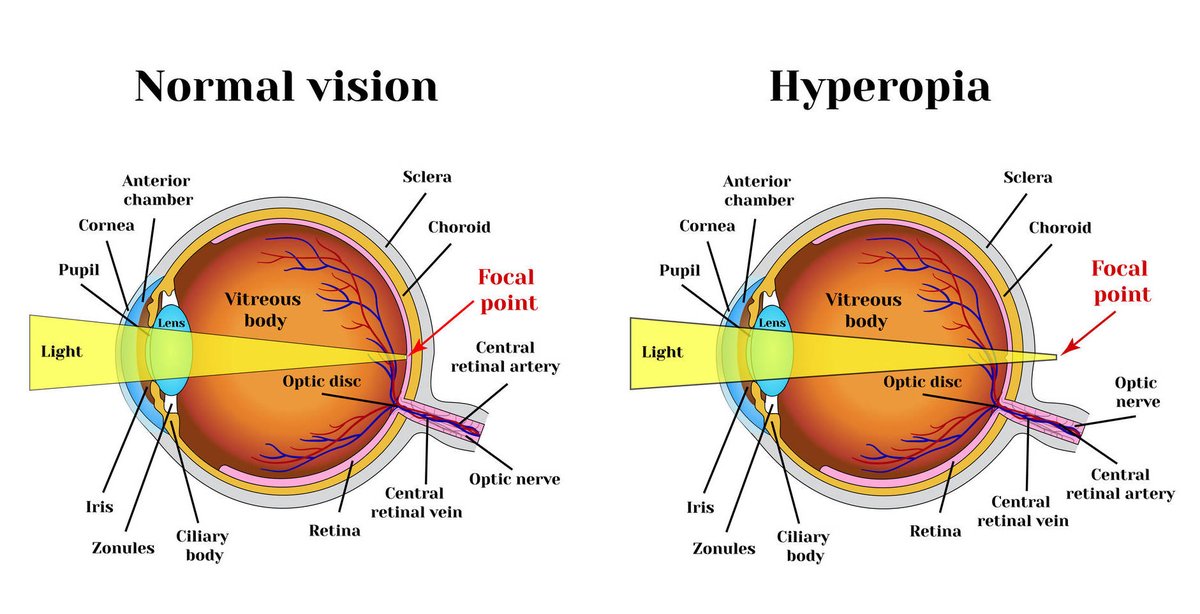 joptoophthal's tweet image. Hypermetropia, also known as long-sightedness is an eye defect. Where the eye is shorter than normal or the cornea becomes too flat. Person suffering from it can see distant objects clearly but is not able to see nearby objects clearly.
#Hypermetropia #eyedefect #lightsensitive