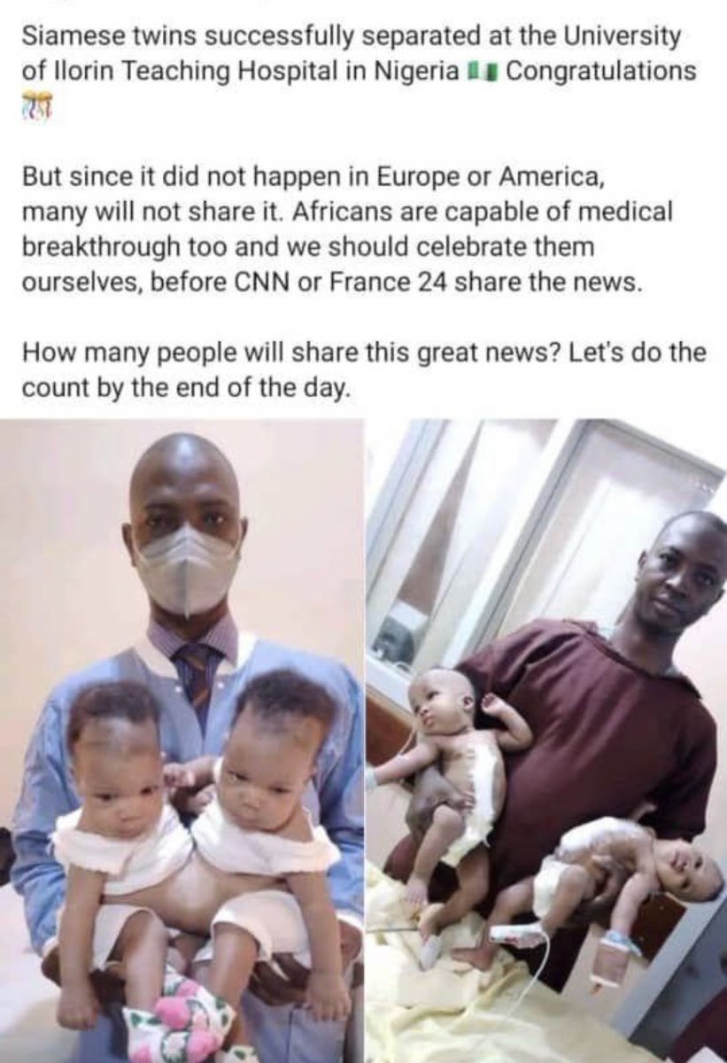 “<a href="/alfatunde/">Ibraheem Raji</a>: <a href="/Gidi_Traffic/">GIDI</a> Why don’t we celebrate our own as Africans, why do we always let the West brain drain our talents.
Siamese twins successfully separated in Uni ilorin Teaching hospital. #Share if you’re proud of African success stories.