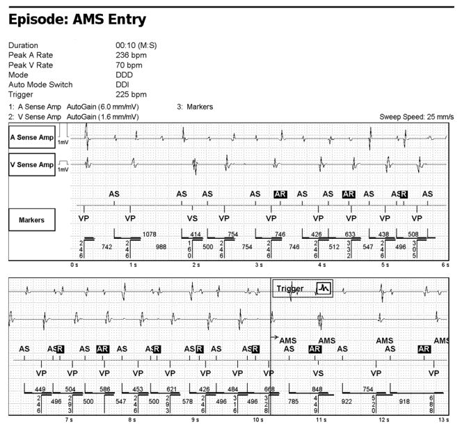 A truly great device case. I have so many images, I almost don't know where to begin to share. Still many images to scan in, but here's a good start. Pt. admitted with palps. Dual chamber pacer in place, with a cardiac history. What is going on? (yes symptoms during fast pacing)