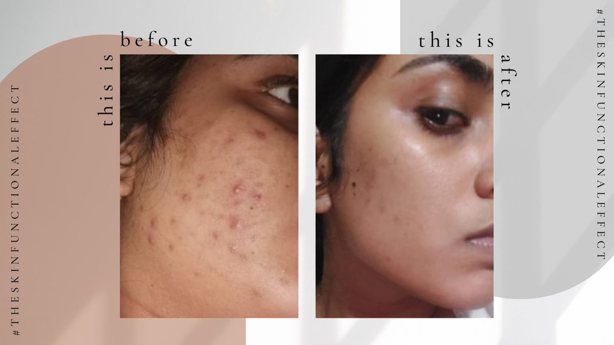 SkinFunctional's tweet photo. #TheSkinFunctionalEffect in full action with the beautiful Shazia Kader. β€οΈ
#skincareza #skinfunctional #cleanbeauty #skinvestment #skincarejourney #acne #beforeandafter #transformation https://t.co/IgWfQyOBey