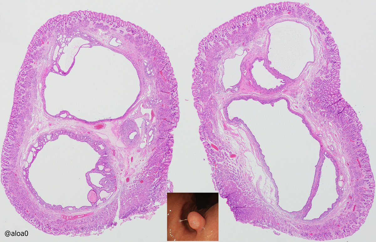 aloa0's tweet photo. Gastric polyp at high body. What would you call it? #GIpath https://t.co/8FxyWYhOac