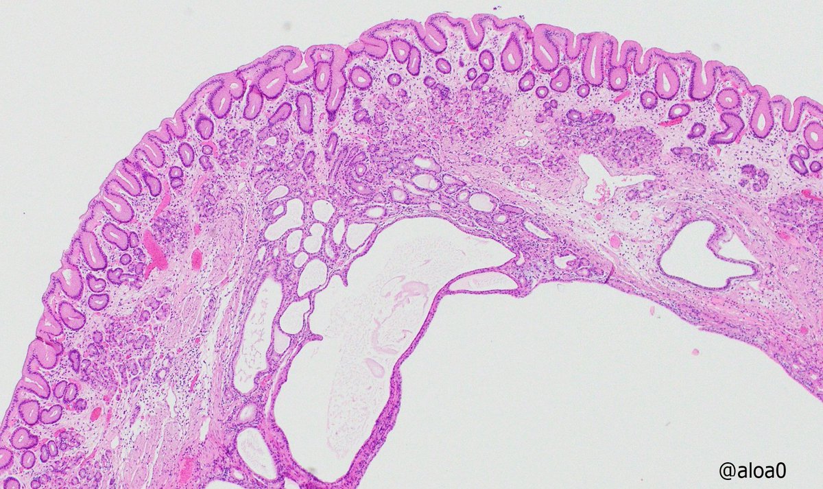 aloa0's tweet photo. Gastric polyp at high body. What would you call it? #GIpath https://t.co/8FxyWYhOac