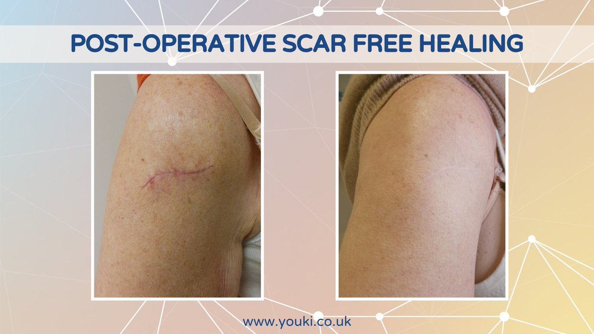 Clinogen's tweet photo. This patient was diagnosed with a malignant melanoma on the upper right arm. The tumour was excised under local anaesthetic resulting in an unsightly scar. The patient began the Youki protocol four weeks post-op leading to scar free skin. #scars #scarfreehealing #woundhealing https://t.co/pRGaHudNzx