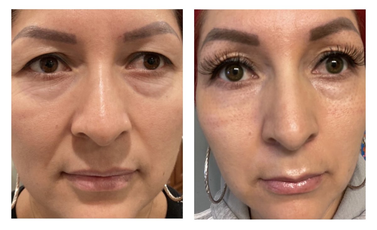 ClinicalSusan's tweet photo. Remember her? Before #plasmapen on her eyelids and now, 2 weeks later. The best is yet to come. 

@PlasmaPen #tulsa #Oklahoma #caotulsa https://t.co/o2NV4SuaSR