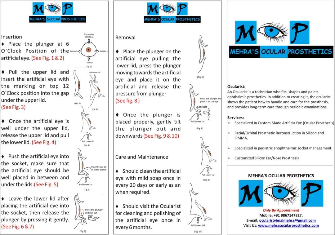 #ocularist #artificialeye #customisedocularprosthesis #mehrasocularprosthetics #ocularprosthesis 
Insertion and removal guide