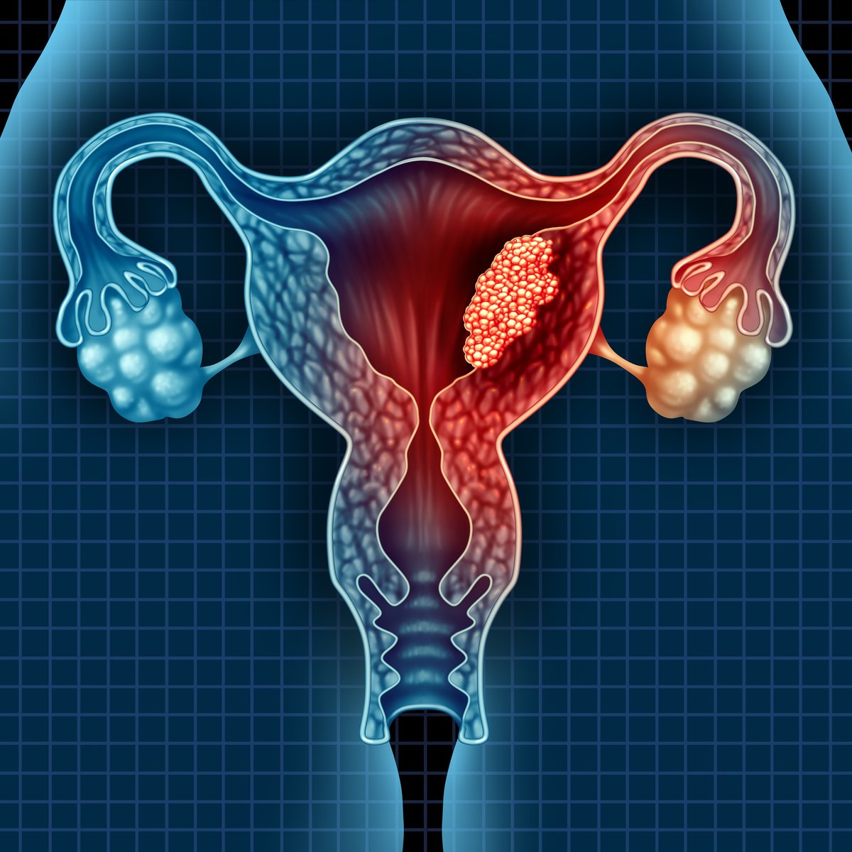 Inside_PM's tweet image. The first in-depth reference map of the uterus to collect both single cell and #spatialtranscriptomic data reveals new insights into the cellular make up of #endometrialcancers and adds to the Human Cell Atlas. Learn more: ow.ly/f5Xz50H35bQ #uterinecancer