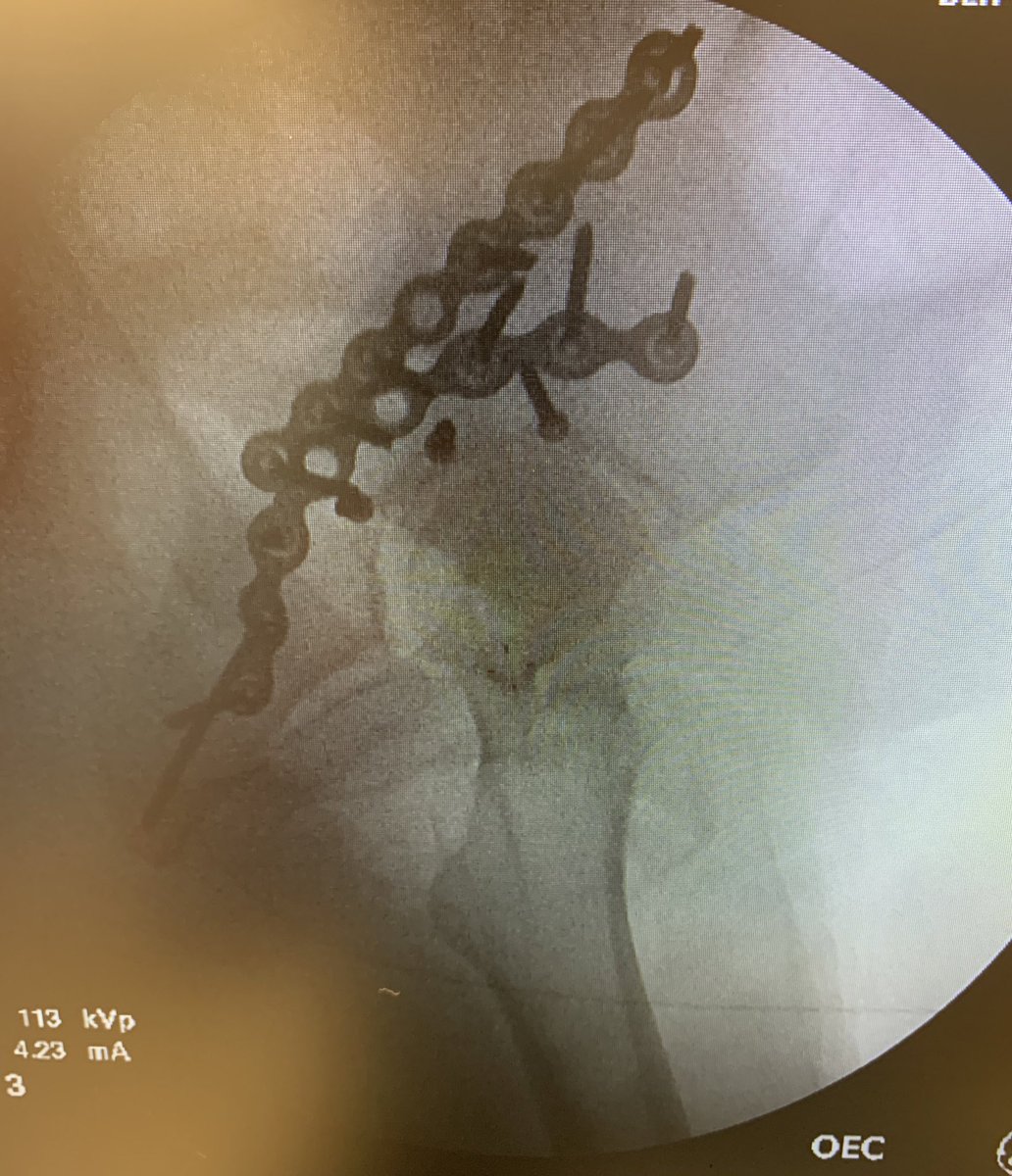 DanielDWang1's tweet photo. Sweet case last night — posterior hip dislocation + transverse-posterior wall acetabular fracture. Big ole’ posterior wall fragment in the joint. Our junior resident made the right call and didn’t pull on this one in the shock room 😳 @BCMOrthoRes #orthotwitter #orthotrauma https://t.co/j1HV3G1TYK