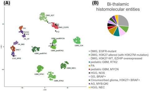 brainpathol's tweet photo. Deciphering the genetic and epigenetic landscape of pediatric #bithalamic tumors: Tauziede-Espariat et al show the central role of comprehensive review, including #ihcpath, genetics, and epigenetics, to achieve accurate diagnosis @GhuParis #neuropath https://t.co/QkycFOXneG https://t.co/btpO7wRrln