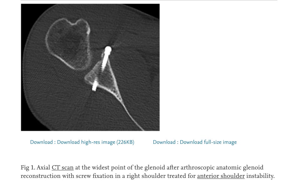 dalsportsmed's tweet photo. #Screw or #SutureButton fixation? This study shows #SutureButton fixation of the allograft is a potential alternative to #screw fixation for the management of #GBL in recurrent #AnteriorShoulderInstability. Check it out here:https://t.co/2PnhC9hQI1
@dalsurgresearch @SportsMedMD https://t.co/VaWloPfWIo