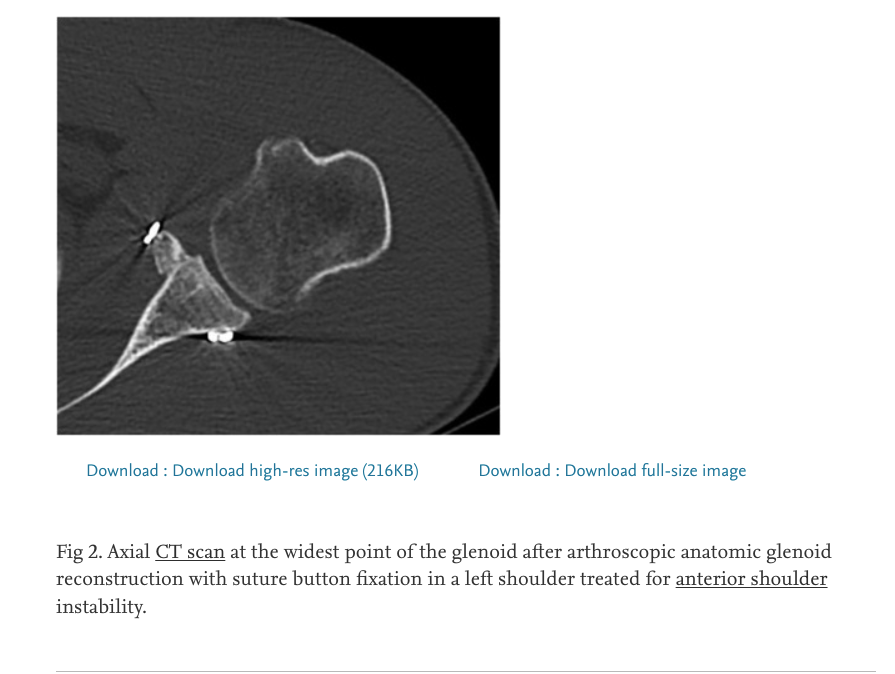 dalsportsmed's tweet photo. #Screw or #SutureButton fixation? This study shows #SutureButton fixation of the allograft is a potential alternative to #screw fixation for the management of #GBL in recurrent #AnteriorShoulderInstability. Check it out here:https://t.co/2PnhC9hQI1
@dalsurgresearch @SportsMedMD https://t.co/VaWloPfWIo