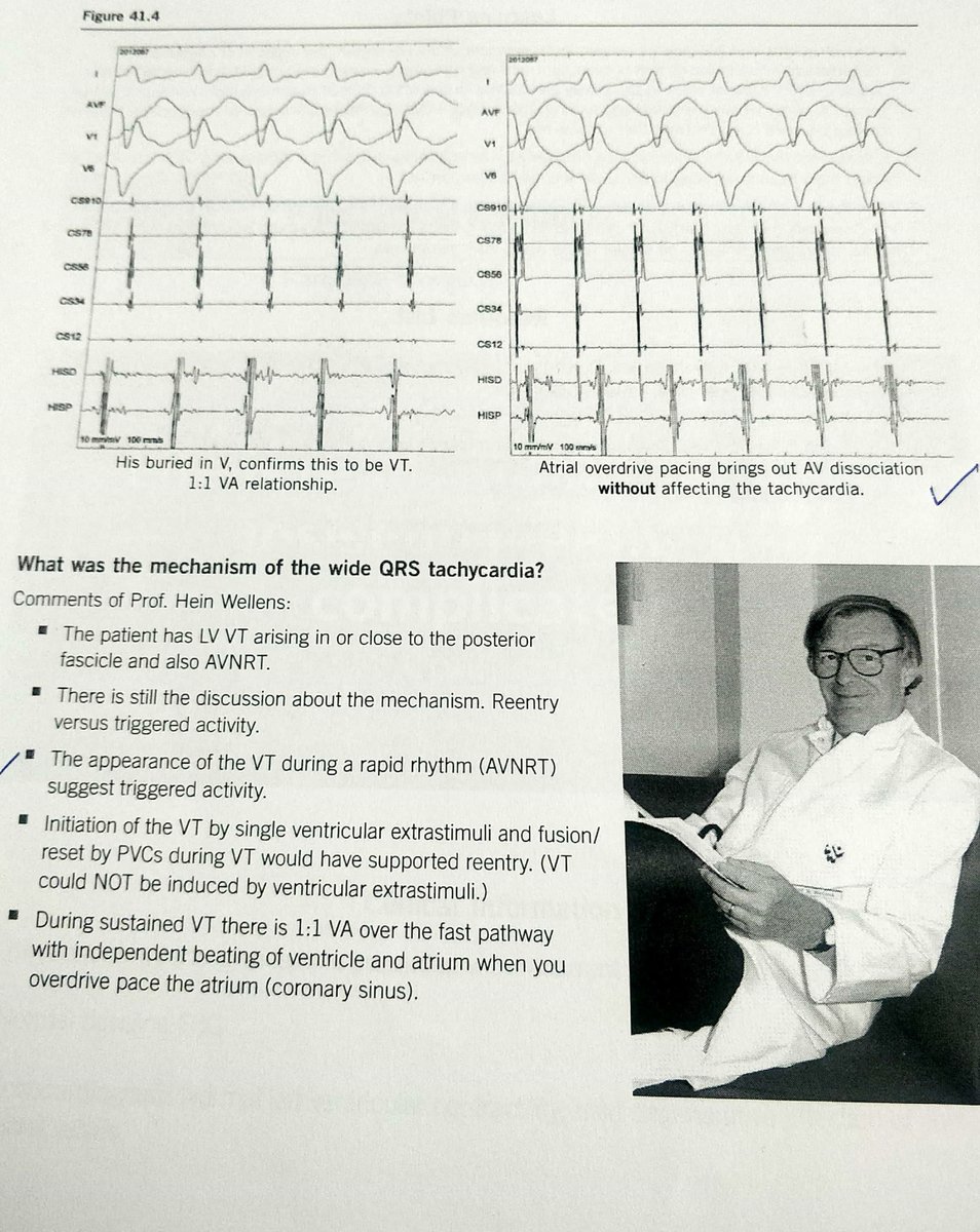 One of the pearls from Dr. Hein Wellens and Dr. Yash Lokhandwala

Sometimes narrow QRS tachycardia-SVT (AVNRT) can initiate wide QRS tachycardia- VT(Fascicular VT)