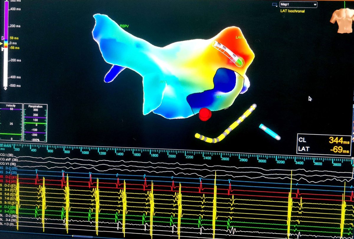 Sometimes left-sided Accessory pathways can be very anterior just at the base of the Left atrial appendage. Successful RF ablation done