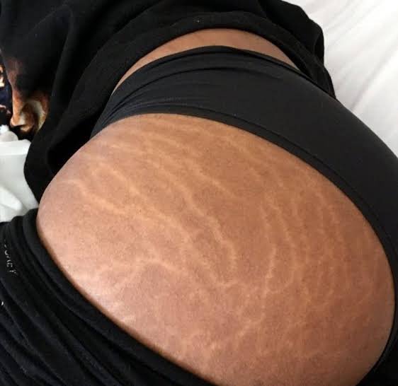 Raxy133's tweet photo. Do you remember when stretch marks were seen in a bad way🥺now it’s a trend,ya sexy when ya got em,be you,ya insecurities will soon turn into beauty trend🔥 https://t.co/56EFzUBE1C