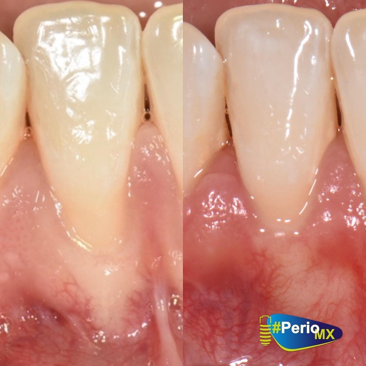 PerioMX's tweet photo. Cobertura radicular con #alloderm
Siempre busca que el manejo de los tejidos sea óptimo:
❇️incisiones
❇️tipo de colgajo
❇️biomateriales
❇️técnica de sutura
El mantenimiento periodontal es fundamental para el éxito a largo plazo. https://t.co/d5vPXHdmLS