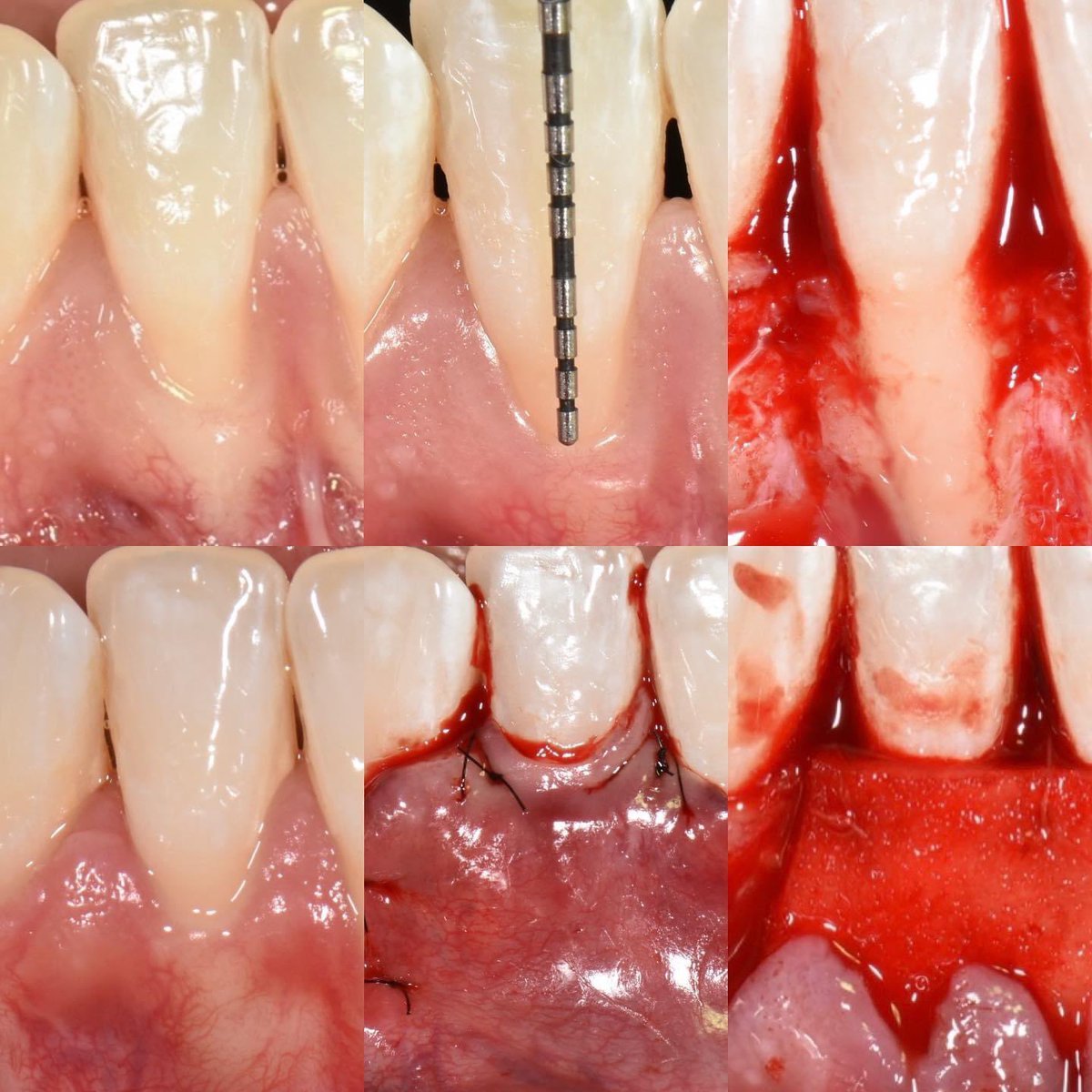 PerioMX's tweet photo. Cobertura radicular con #alloderm
Siempre busca que el manejo de los tejidos sea óptimo:
❇️incisiones
❇️tipo de colgajo
❇️biomateriales
❇️técnica de sutura
El mantenimiento periodontal es fundamental para el éxito a largo plazo. https://t.co/d5vPXHdmLS