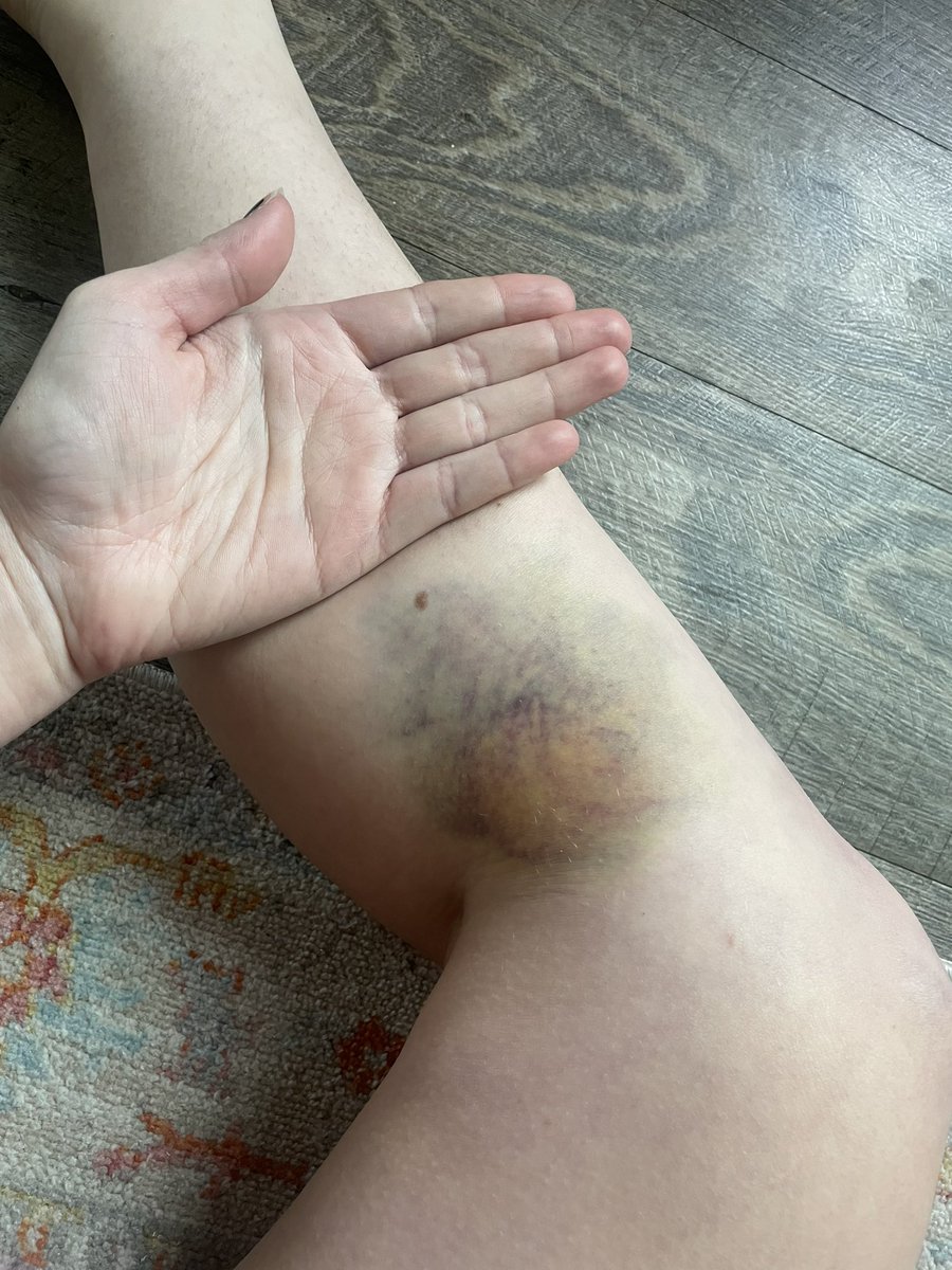 bunnybattleaxe's tweet photo. Update on my impressive bruise https://t.co/ChI1mMc99x