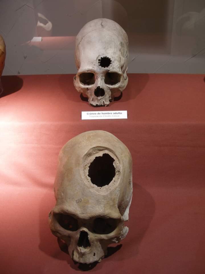 Archeological remains of patients of brain surgery performed by ancient doctors of Inca Empire in 15th century.

Incan people practiced brain surgery, in which a piece was chipped out of skull, part of brain removed and hole covered by metal beaten flat.

Larco Museum, Lima, Peru