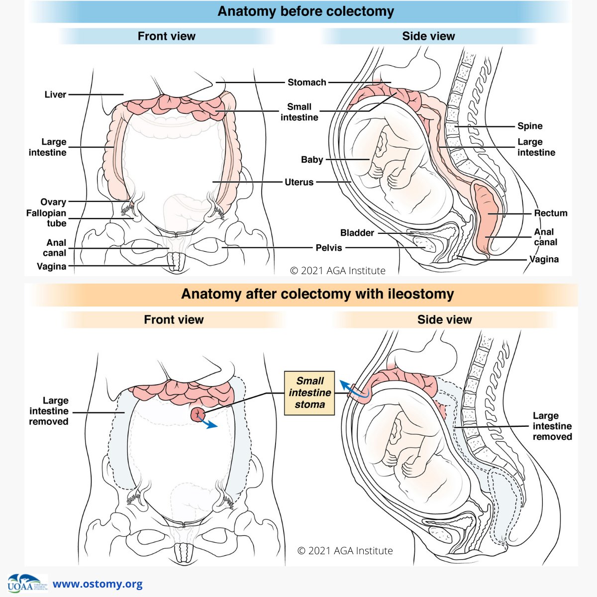 Can you have a baby if you have an ostomy and IBD? For #CCAwarenessWeek we’re launching webpages devoted to these questions with illustrations created in partnership with <a href="/AmerGastroAssn/">American Gastroenterological Association (AGA)</a>. This project is funded with a grant from <a href="/HelmsleyTrust/">Helmsley Charitable Trust</a>. #IBDVisible
ostomy.org/pregnancy/